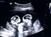 Dua Janin Diduga Bayi Kembar Ditemukan di Septic Tank Apartemen Malang